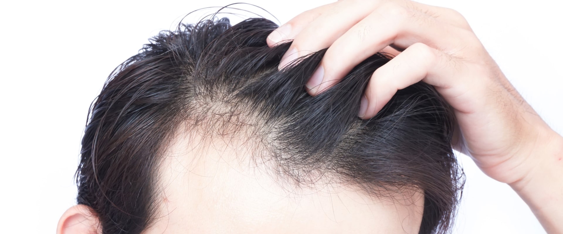 Is hair loss reversible?