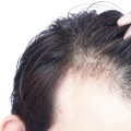 Is hair loss reversible?