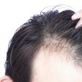 Can permanent hair loss grow back?