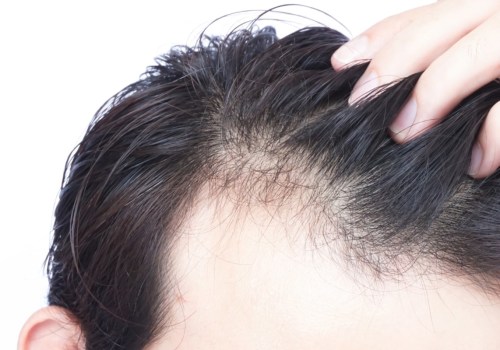 Is hair loss reversible?