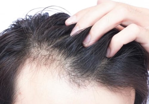 Can permanent hair loss grow back?