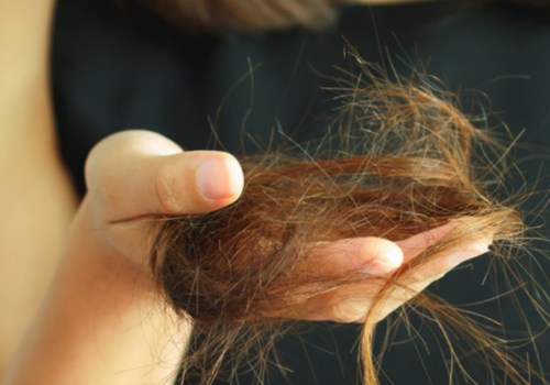 How long does hair loss last after losing weight?